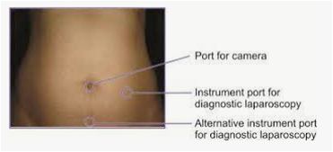 File:Port positions for Laparoscopy.png