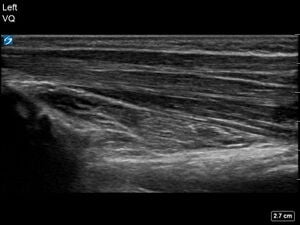 Ultrasound Scan - Pronator Quadratus of Unaffected Left Forearm - 6-Year-Old Female Patient with Right Incompete Fracture with Cortical Break of Dorsal Radius.jpg