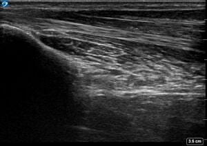 Ultrasound Scan - Pronator Quadratus Sweep of Ipsilateral Forearm - Healthy Adult.jpg