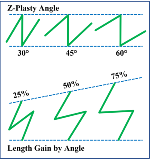 Z-Plasty Angle and Length Gain.png
