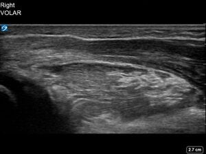 Ultrasound Scan - Right PQH Sign - 6-Year-Old Female Patient with Right Incompete Fracture with Cortical Break of Dorsal Radius.jpg
