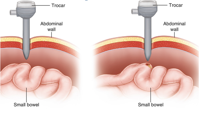 File:Trocar Injury to Small Bowel.png
