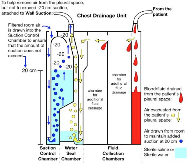Chest Tube Mangement Appropedia, the sustainability wiki