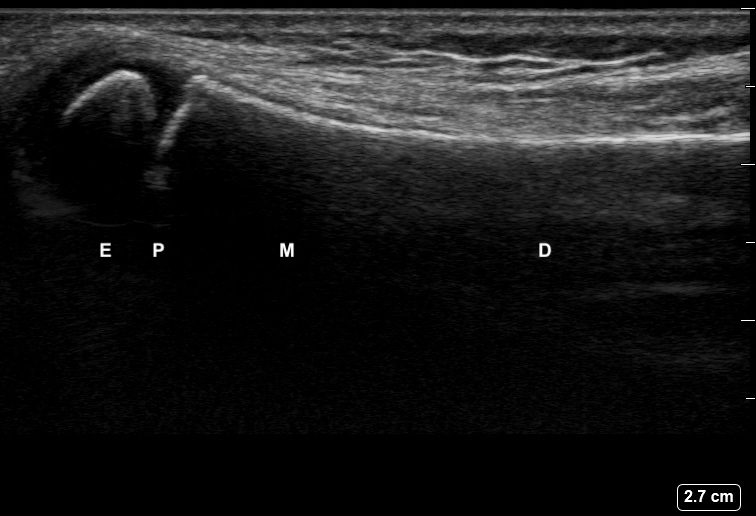 File:Ultrasound Labelled Scan - Dorsal Ulna View - 12-Year-Old Male Patient.jpg