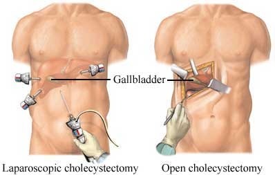 File:Laparoscopic Cholecystectomy.jpg