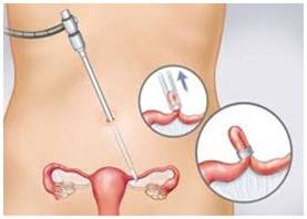 File:Laparoscopic Sterilization in Females.jpg