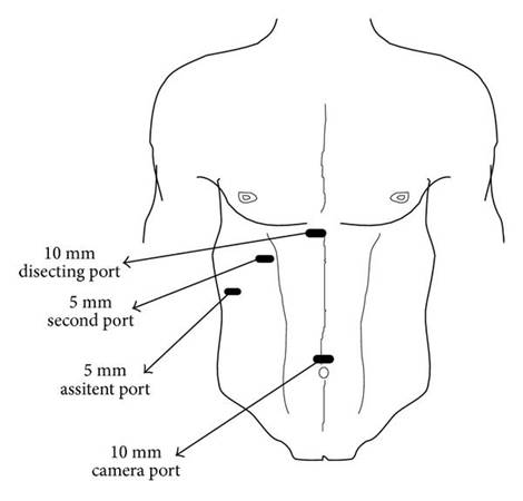 File:Ports for Laparoscopic Cholecystectomy.jpg