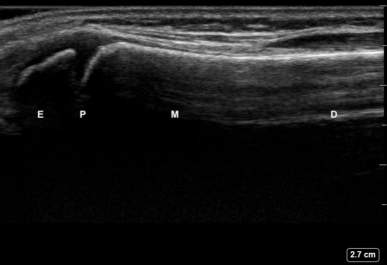 File:Ultrasound Labelled Scan - Dorsal Radius View - 12-Year-Old Male Patient.jpg