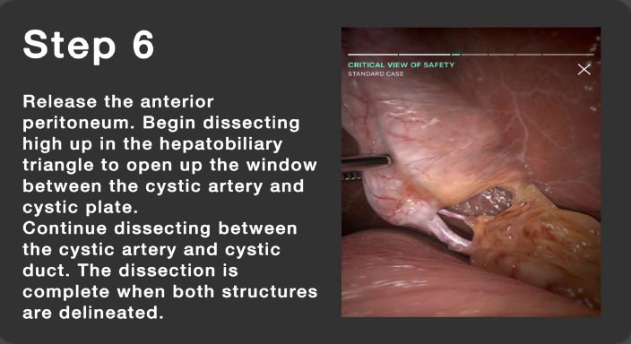 File:Step-6 - Laparoscopic Operation.jpg