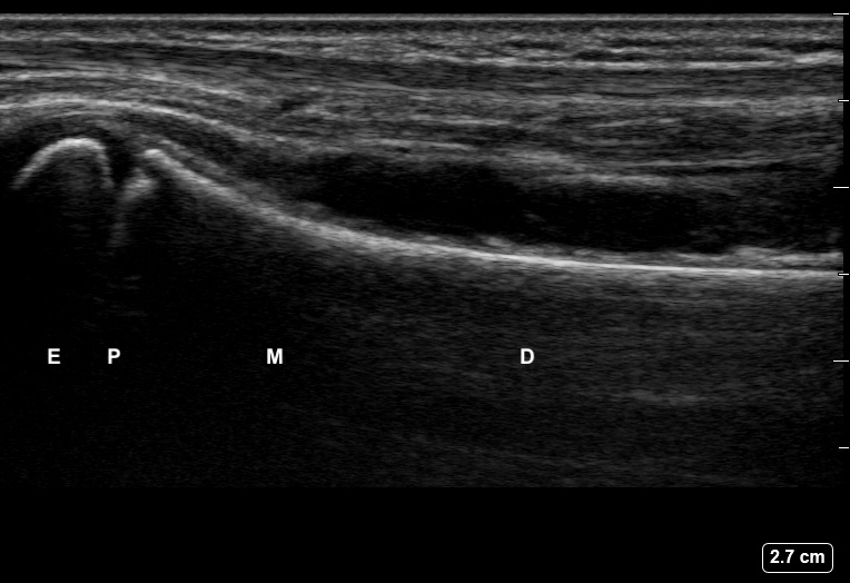 File:Ultrasound Labelled Scan - Volar Ulna View - 12-Year-Old Male Patient.jpg