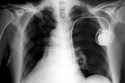 File:Pacemaker in body.jpg