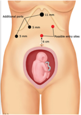 File:Laparoscopic Surgery during Pregnancy.png