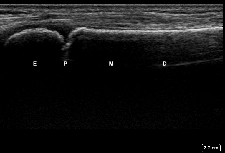 File:Ultrasound Labelled Scan - Lateral Radius View - 12-Year-Old Male Patient.jpg