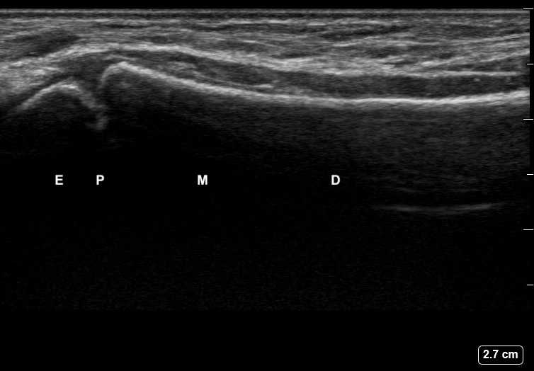 File:Ultrasound Labelled Scan - Volar Radius View - 12-Year-Old Male Patient.jpg