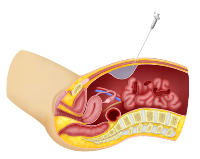 File:Insufllation of Subcutaneous Layer.png