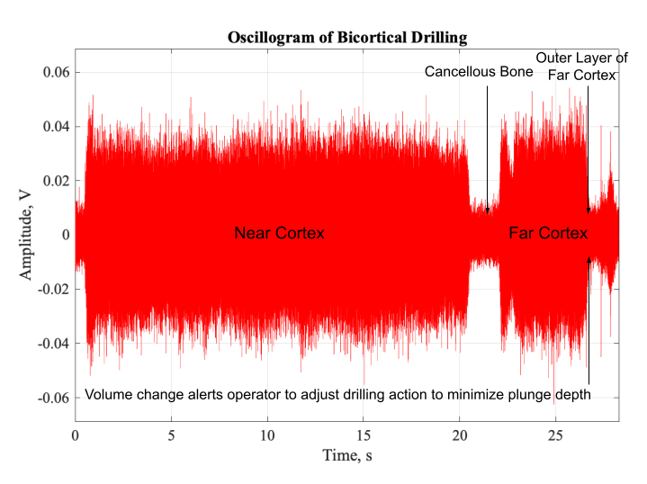 File:Oscillogram of Bicortical Drilling of Tibial Fracture v2.0.png