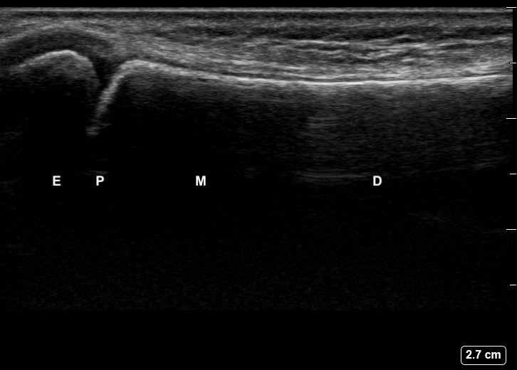 File:Ultrasound Labelled Scan - Lateral Ulna View - 12-Year-Old Male Patient.jpg