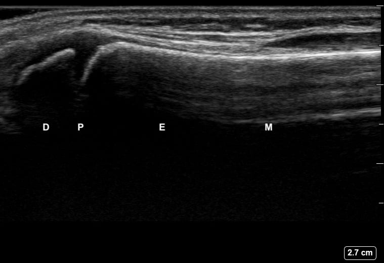 File:Ultrasound Incorrectly Labelled Scan - Dorsal Radius View - 12-Year-Old Male Patient.jpg