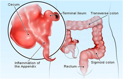 File:Inflamed Appendix.png