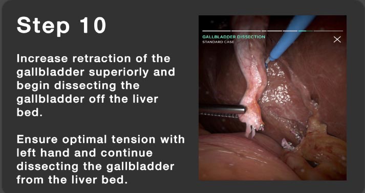 File:Step-10- Laparoscopic Operation.jpg