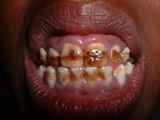 File:Dentalfluorosis.jpg