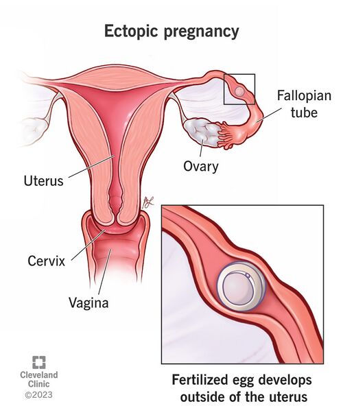 File:9687-ectopic-pregnancy.jpg