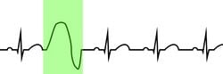 Figure 3. Sinus rhythm with a highlighted premature ventricular contraction (PVC).
