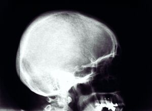 Skull X-Ray.jpg