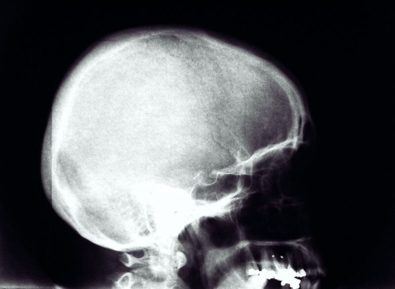 File:Skull X-Ray.jpg