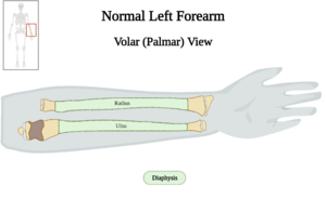 Normal Left Forearm of 10 y.o. Female - Diaphysis v2.0.png