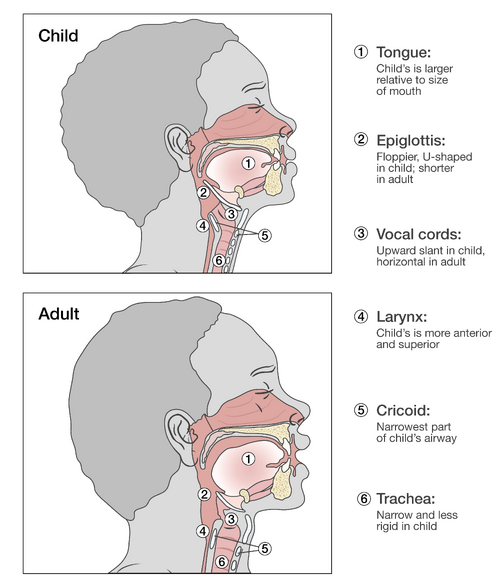 Side-by-side labelled cutaway diagrams of a child's and an adult's head and neck, numbering six airway structures: tongue, epiglottis, vocal cords, larynx, cricoid and trachea.