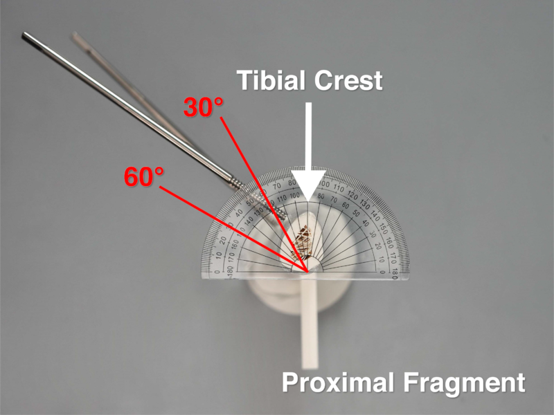 File:Cross-Section View of Proximal Fragment -Uniplanar External Fixation v2.0.png