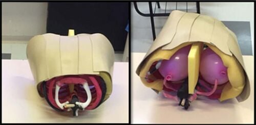 Two photographs of the finished chest drain simulator: on the left the closed model with a cream skin and soft-tissue shell over the printed ribcage, and on the right the same model with the shell lifted to show a yellow inner layer and two pink inflated balloons standing in for the lungs.