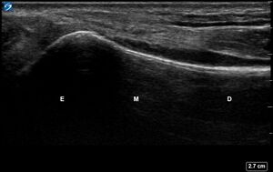 Ultrasound Labelled Scan - Volar Radius - Healthy Adult.jpg.jpg