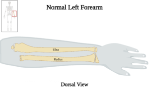 Normal Left Forearm of 10 y.o. Female - Dorsal View.png
