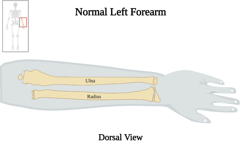 File:Normal Left Forearm of 10 y.o. Female - Dorsal View.png