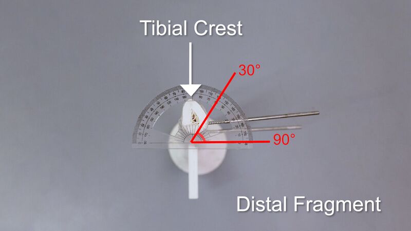 File:Cross-Section View Photo of Drill Trajectory Angles of Schanz Screws in Distal Fragment v4.0.jpg