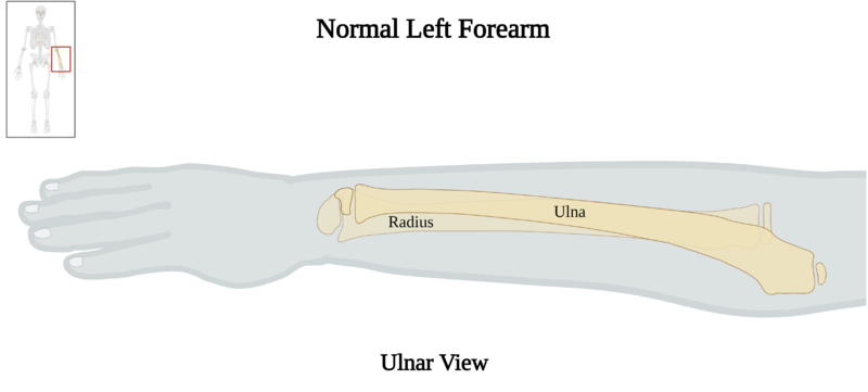File:Normal Left Forearm of 10 y.o. Female - Ulnar View.png