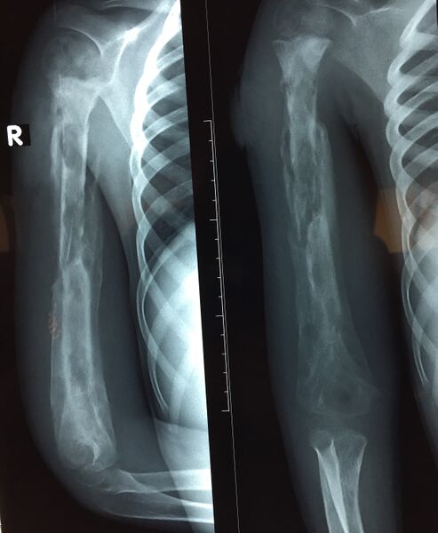 File:Chronic osteomyelitis X-ray photo.jpg