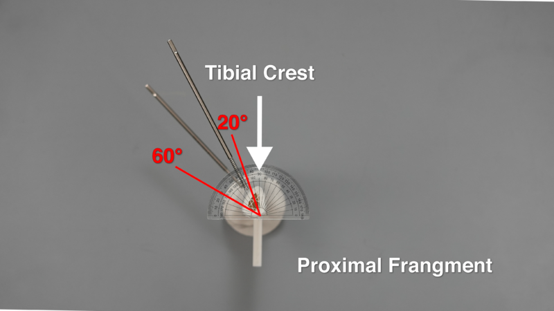 File:Cross-Section View Photo of Drill Trajectory Angles of Schanz Screws in Proximal Fragment v3.0.png