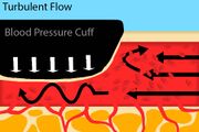 Fig. 4: An artery with a blood pressure cuff where the cuff pressure is less than the systolic, but still greater than the diastolic blood pressure.