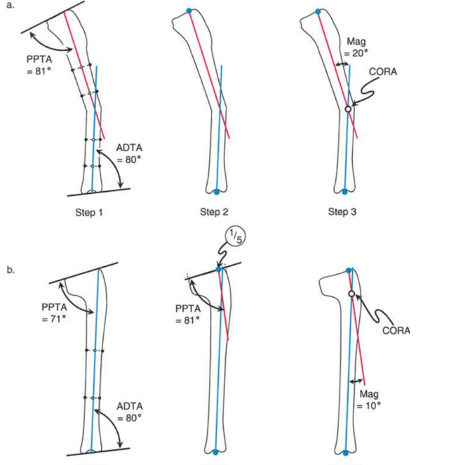 Mechanical and Anatomical Axis Planning Sagittal plane