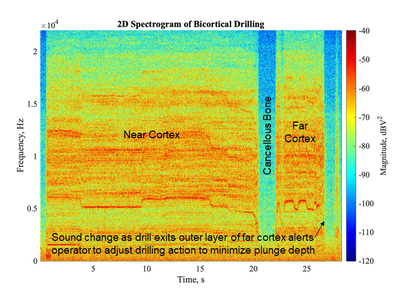 2D Spectrogram of Bicortical Drilling of Tibial Fracture v2.0.png