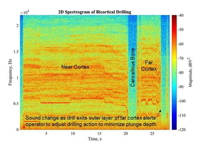 2D Spectrogram of Bicortical Drilling of Tibial Fracture