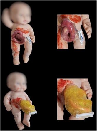 Front views of the two finished neonatal mannequins with close-up panels: on the gastroschisis model a bowel loop protrudes beside a clamped umbilical cord, and on the omphalocele model the contents sit inside a yellow membranous sac.