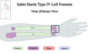 Salter-Harris Type IV Fracture of Left Forearm of 10 y.o. Female v4.0.png