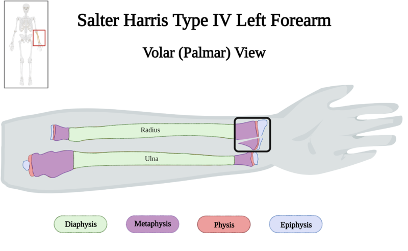 File:Salter-Harris Type IV Fracture of Left Forearm of 10 y.o. Female v4.0.png