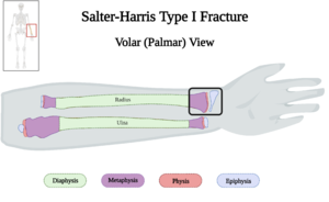 Salter-Harris Type I Fracture of Left Forearm of 10 y.o. Female v4.0.png