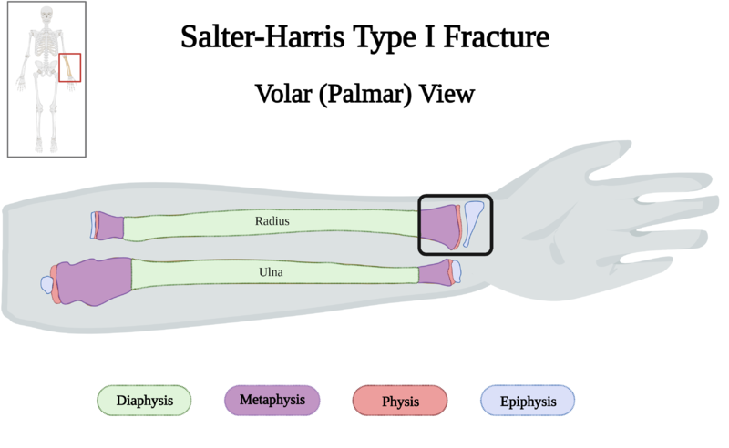 File:Salter-Harris Type I Fracture of Left Forearm of 10 y.o. Female v4.0.png
