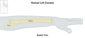 Normal Left Forearm of 10 y.o. Female - Radial View.png
